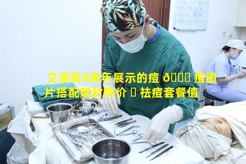 艾美莉8周年展示的痘 🐕 痘图片搭配限时特价 ☘ 祛痘套餐值得尝试吗